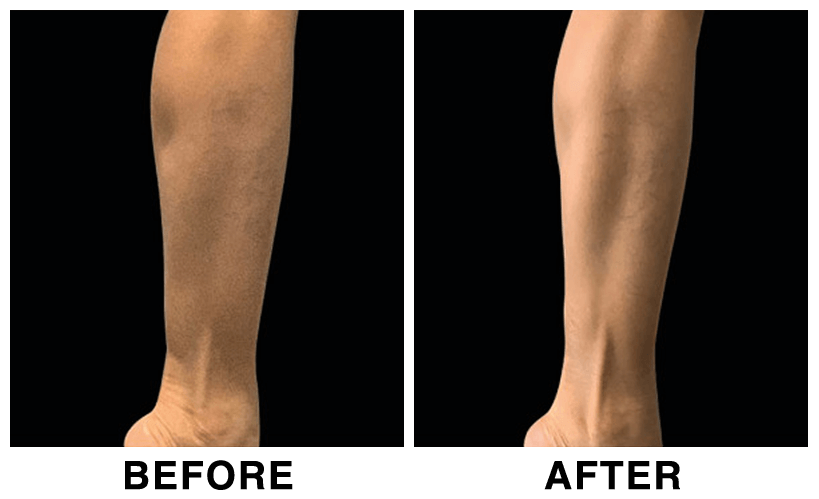 HIFEM-Treatment-Before-and-After-legs