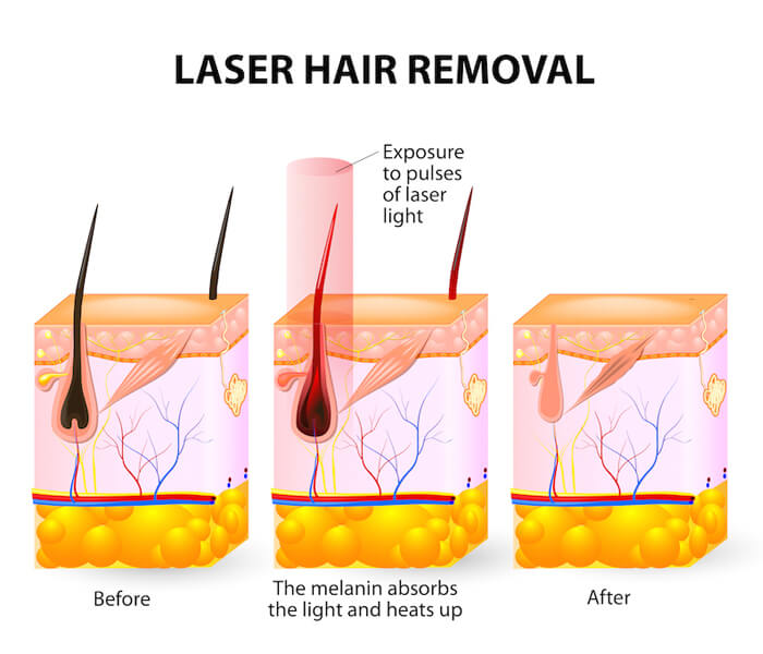How Does A Diode Laser Work?