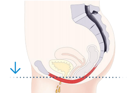 Pelvic floor muscles insufficiently support pelvic organs and affect bladder control.