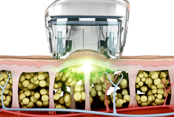 Vacuum RF working principle