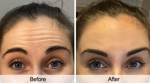 skin-resurfacing-before-after