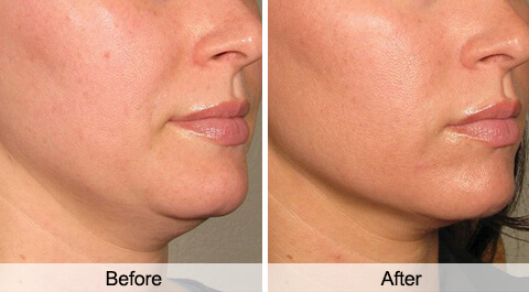 skin-tightening-before-after